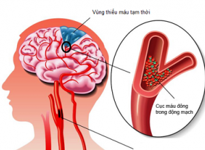 Thiếu máu lên não nguyên nhân là gì? Cùng tìm hiểu về tình trạng thiếu máu lên não